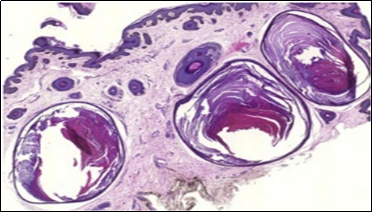  Nevus comedonicus  with         aggregated follicular ostia, lamellated keratin, hyperkeratotic stratified           squamous epithelial lining  and an          attenuated superimposed epithelium12.