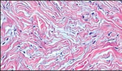  Soft tissue perineurioma with fascicles of bipolar neural cells with elongated cytoplasmic processes, wavy nuclei  and an admixture of                 collagen fibres 11.