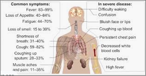  Some symptoms of COVID-19 https://upload.wikimedia.org/wikipedia/commons/3/33/Symptoms_of_coronavirus_disease_2019_4.0.svg