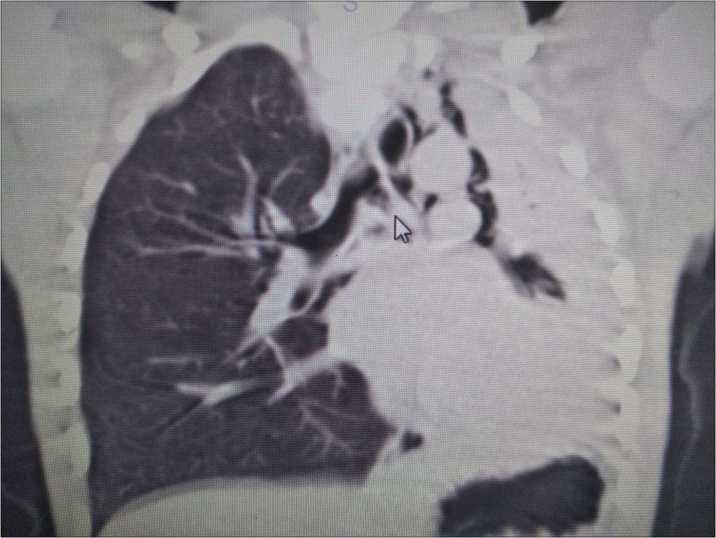 HRCT of the patient showing narrowing of the left main stem bronchus starting from carina downwards.