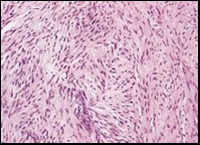  Low grade fibromyxoid sarcoma composed of alternating foci of fibrous and myxoid region with interwoven fascicles and bland spindle-shaped     tumour cells (12).