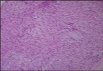  Low grade fibromyxoid sarcoma delineating alternating fibrous and myxoid areas of minimal             cellularity and mitosis (9).