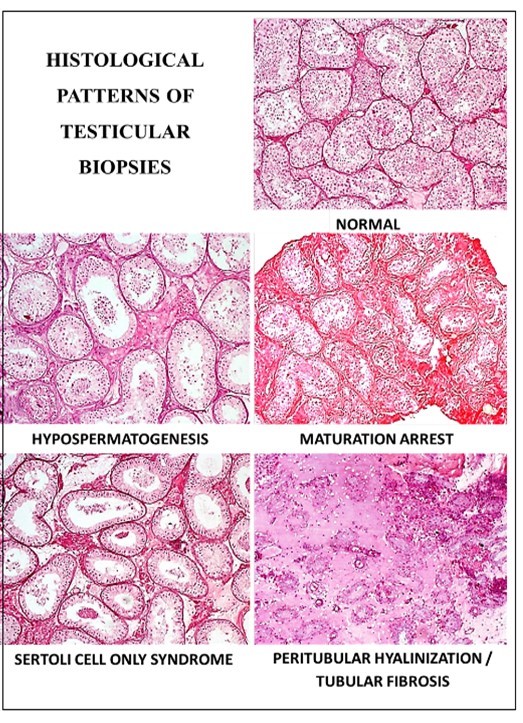  Different Histological Pattern of testicular biopsy