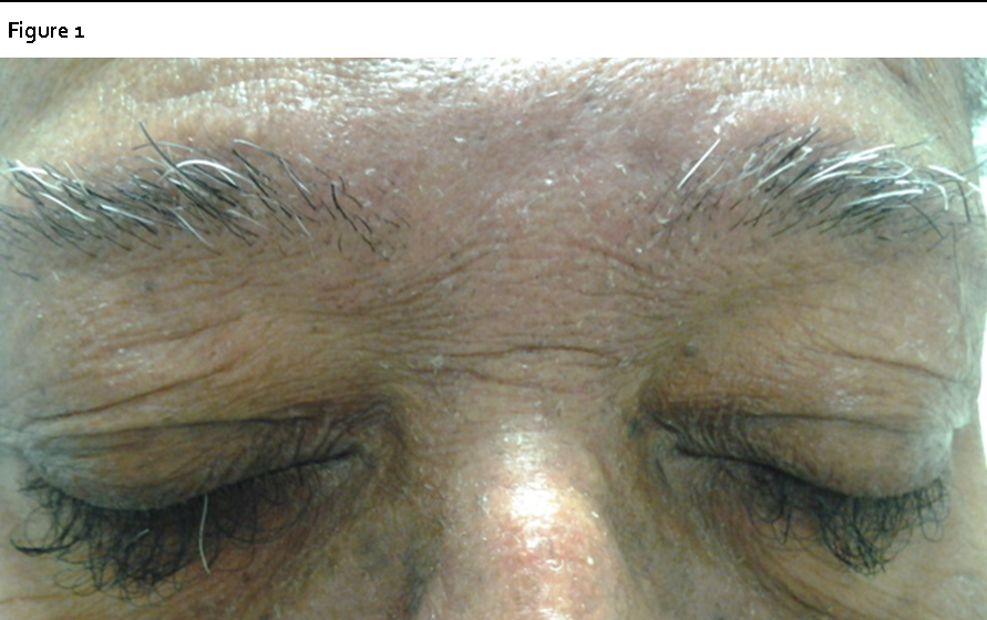  Note loss of eyebrow hair with paradoxical trichomegaly and trichiasis of the eyelashes.