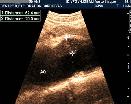 Partially thrombosed 5.2cm fusiform suprarenal AAA with extension to the superior mesenteric artery in a 59-year-old subject (CEC 'Saint-Esprit' of the AMP-MCV).