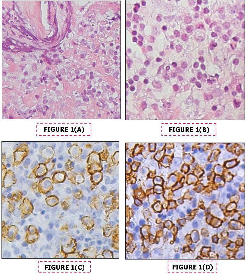  Findings on paraffin – embedded bone marrow trephine biopsy sections, A- Interstitial deposits of amorphous eosinophilic Congo-red negative substance H&EX40 , B-Infiltrate of small lymphoid cells. H&E, x40, C- Cd138 immunostaining, x40, D- Cd20 immunostaining x40