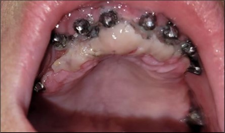 Appearance of the mucosa from where the tissue was harvested and of the implants, 2 days after the corrective intervention.