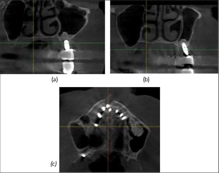 (a), (b) Sinus lift and grafting area with two stage implants before their removal. (c) area of fixation of BCS and TPG implants, avoiding the sinus lift and grafting area