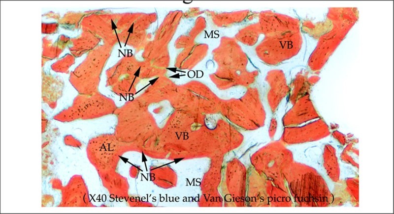 Figure 2. Medium power histology view. Formation of immature new bone with osteoid formation. VB: mature vital bone. AL: Allogeneic bone. NB: immature new bone. MS: Marrow space. OD: Osteoid. Original magnification x 40. Stevenel’s blue and Van Gieson’s picro fuchsin.