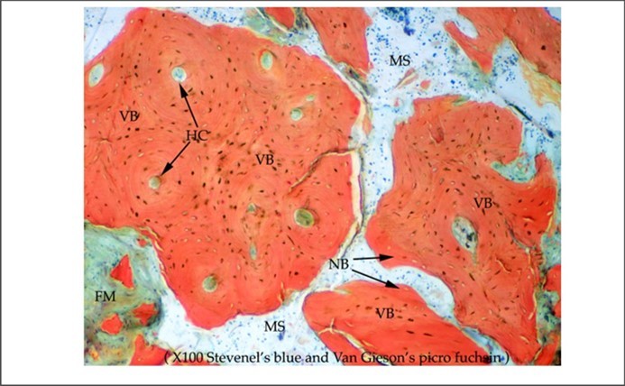 Figure 3. High power histology view. Neovascularization illustrated by the presence of multiple haversian canals that provide the vascular supply to newly formed osteocytes. VB: mature vital bone. NB: immature new bone. MS: Marrow space. HC: Haversian canal. FM: Fibrous marrow. Original magnification x 100. Stevenel’s blue and Van Gieson’s picro fuchsin.
