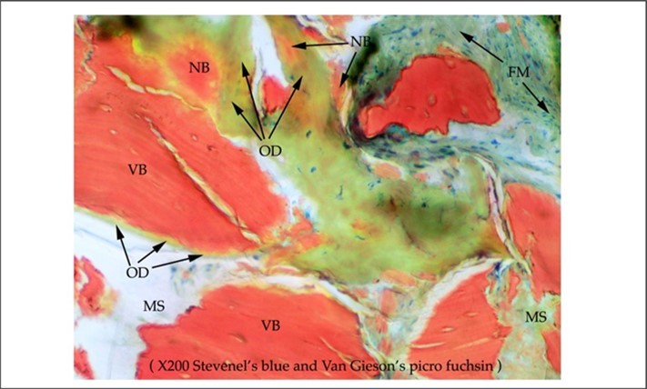 Figure 4. High power histology view. Dense new vital autogenous bone with a wide seam of green-staining osteoid. VB: mature vital bone. NB: immature new bone. MS: Marrow space. HC: Haversian canal. FM: Fibrous marrow. OD: Osteoid. Original magnification x 200. Stevenel’s blue and Van Gieson’s picro fuchsin.